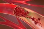Cara Mencegah Arteriosklerosis Tips untuk Kesehatan Jantung Anda